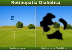 retinopatia diabetica...come si vede