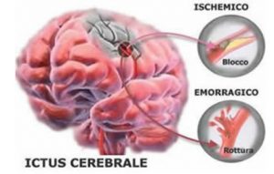 ictus cerebrale