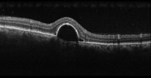 Corioretinosi sierosa centrale - scansione OCT