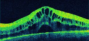 Edema maculare diabetico - scansione OCT