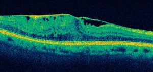 Pucker maculare - scansione OCT