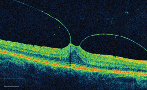 Trazione vitreo maculare - scansione OCT