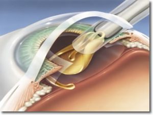 Lente intraoculare cristallino artificiale